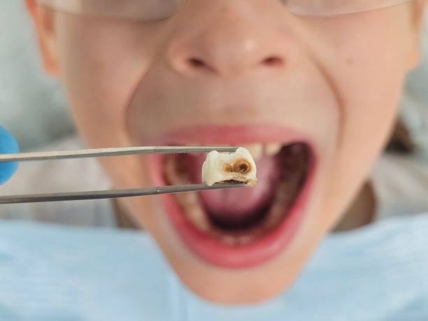 Tooth Infection Emergency Dentist in IA
